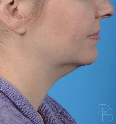 Facial & Neck Liposuction Before & After Image