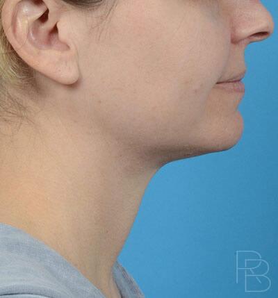 Facial & Neck Liposuction Before & After Image