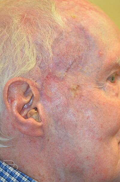 Skin Cancer Mohs Reconstruction Before & After Image